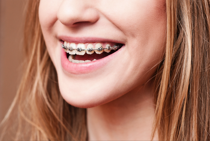 FAQs About Traditional Braces' Colors in Roseville, CA