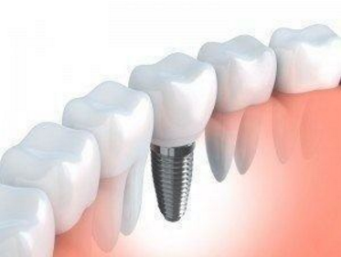 Should One Consider a Dental Implant Restoration, Yes or No?